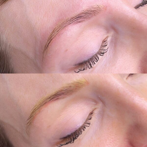 Vorher-Nachher Ergebnis nach Permanent Make-up Entfernung der Augenbrauen mit Remover in Hamburg