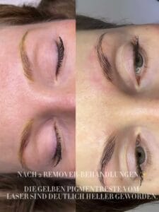 Vorher-Nachher der Augenbrauen nach zwei Remover-Behandlungen zur Permanent Make-up Entfernung in Hamburg