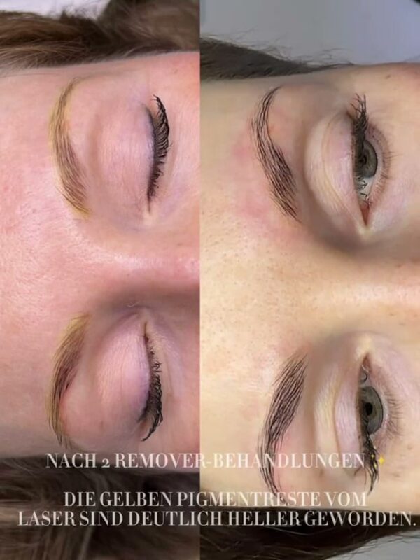 Vorher-Nachher der Augenbrauen nach zwei Remover-Behandlungen zur Permanent Make-up Entfernung in Hamburg